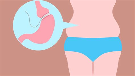 Gastroparesis Life Expectancy: What You Need to Know