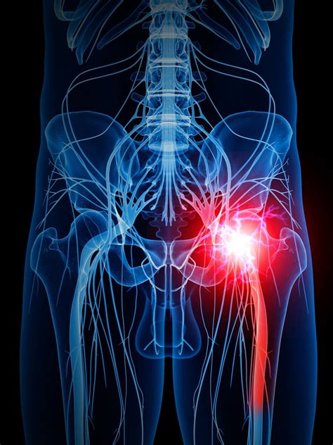 Taming the pain of sciatica: For most people, time heals and less is ...