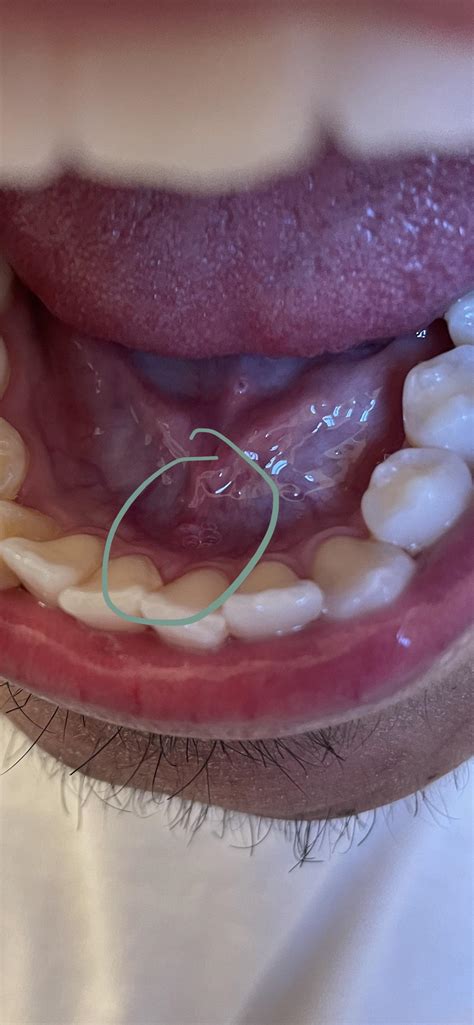 Skin Tag Under Tongue Canker Sore Understanding Canker Sores: Causes