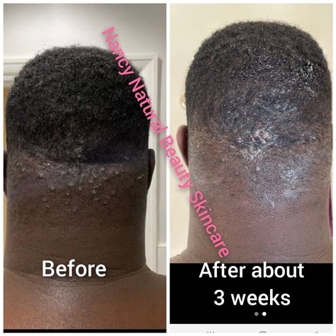 Natural bump stopper cream and soap folliculitis razor bumps – Artofit