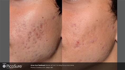 Pico - Acne Scars Removal Blog
