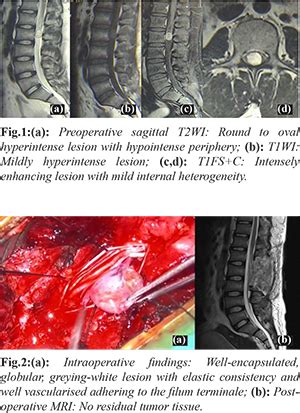 An Uncommon Case of Filum Terminale Paraganglioma