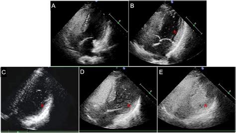 Frontiers | Synchronous multimode ultrasound for assessing right-to-left shunt: a prospective ...