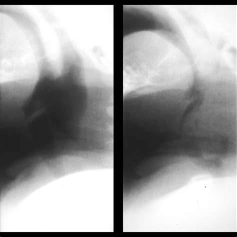 Laryngomalacia | Pediatric Radiology Reference Article | Pediatric ...