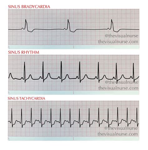 Idioventricular Rhythm Vs Junctional
