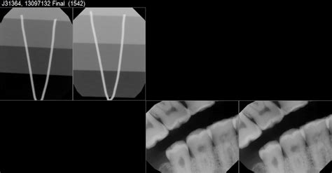 Dexis Titanium Sensor 的图像结果
