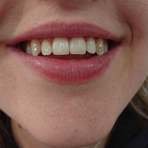 Swarovski Tooth Crystals | Dental jewelry, Tooth gem, Diamond teeth