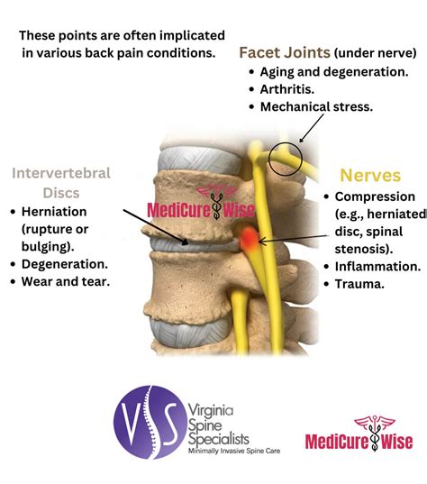 Image result for Lower Back Pain Chart