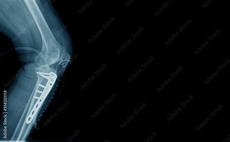 Proximal Tibia 的图像结果