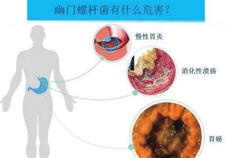 幽门螺杆菌阳性 幽门螺杆菌阳性的危害_毒品相关知识_上海凯创生物