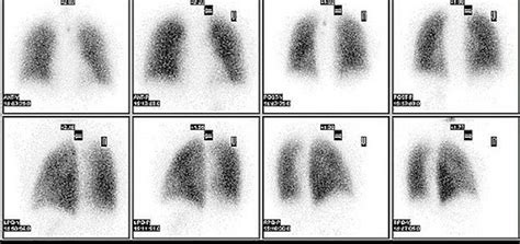 Image result for Radionuclide Scan