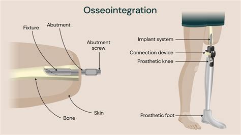 Revolutionary osseointegration surgery transforms the life of ...