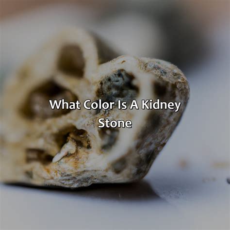 What Color Is A Kidney Stone - colorscombo.com