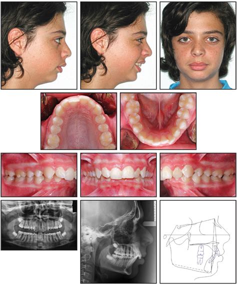 Orthodontic Treatment Of Class 2 Malocclusion' at Will Pedroza blog