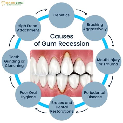 Signs Of Receding Gums