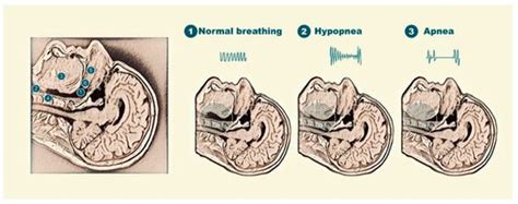 Obstructive Sleep Apnea: Emerging Treatments Targeting the Genioglossus ...