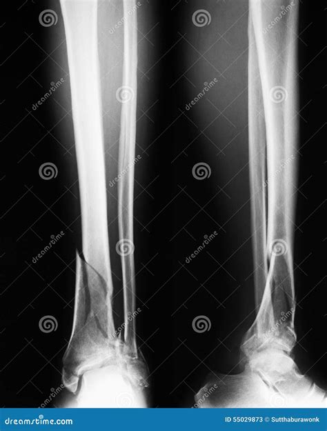 X-ray Image of Broken Leg, Show Tibia and Fibula Fractures. Stock Image - Image of tibia ...