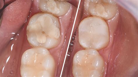 Für die schnelle und günstige Basisversorgung | Quintessenz Verlags-GmbH