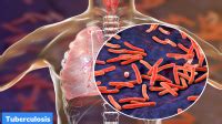 National Tuberculosis Prevalence Survey – GKToday