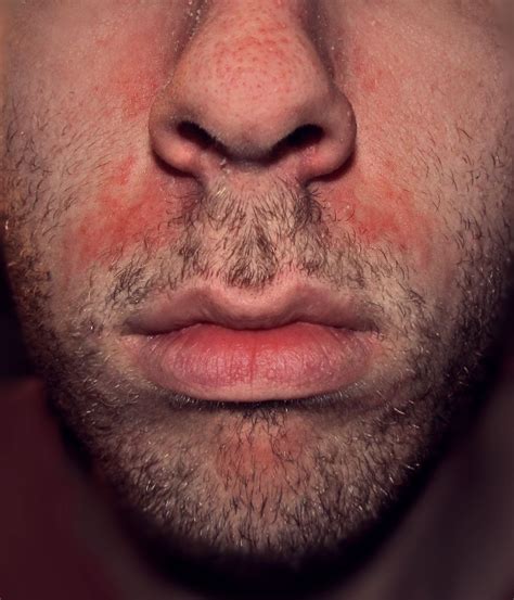Rash Around Nose And Mouth