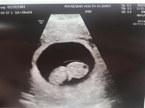 8 Week Ultrasound
