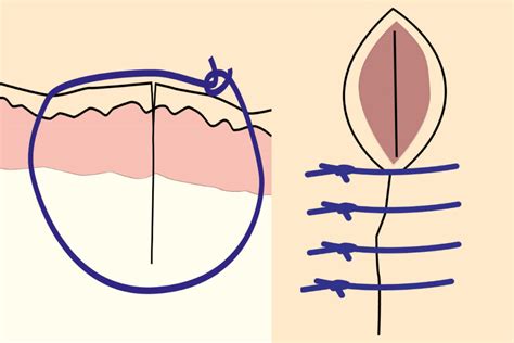 Image result for Common Suture Patterns