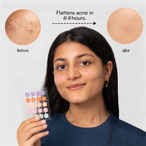 Shop Dart It - Tea Tree & Hydrocolloid Acne Pimple Patches for Zits ...