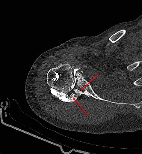 Prothese gut, alles gut? – the unhappy shoulder replacement ...