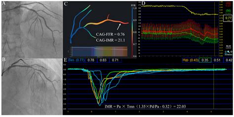 Validation of a Novel Coronary Angiography-Derived Quantitative ...