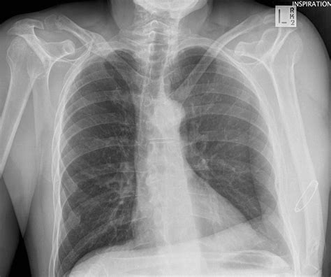 Sternoclavicular Joint Dislocation • LITFL • Trauma library