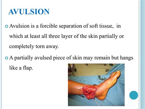 wound ppt.pptx, wound dressing , indication, types, procedure, | PPTX