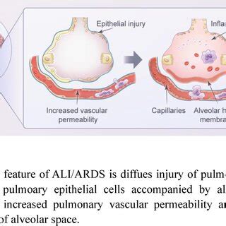Image result for Ali vs Ards PaO2/FiO2