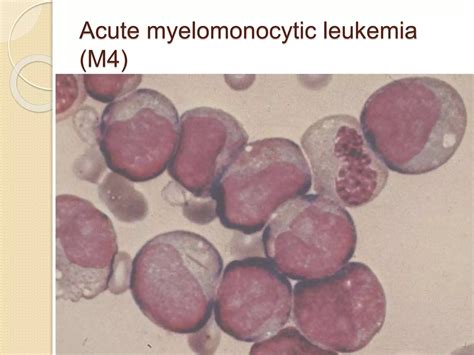Acute myeloid leukemia | PPTX