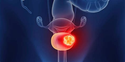 Bladder Cancer 的图像结果