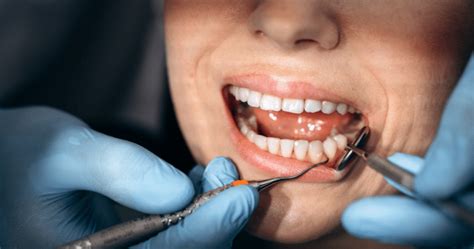 Tooth Extraction 的图像结果