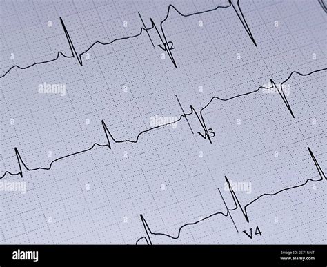 ECG ElectroCardioGraph paper that shows inferolateral T wave changes ...