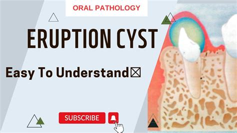 Image result for Exploding Mouth Cyst