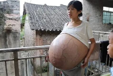 我“怀孕”了，“胎儿”40多斤，被忽视的妇癌之王，刺痛着14万女性__中国医疗