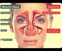 Image result for Sinus Infection