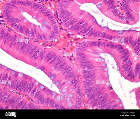Tubular colon polyp, light micrograph. This specimen shows tissue from a tubular adenoma ...