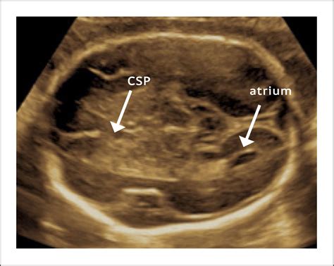 ROL DE LA NEUROSONOGRAFÍA EN LA EVALUACIÓN NEUROLÓGICA FETAL | Revista ...