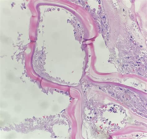 Liver abscess aspiration. Pretreated for suspected disease by ID. : r ...