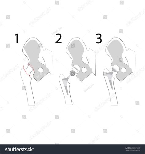 Steps Anterior Approach Hip Replacement: เวกเตอร์สต็อก (ปลอดค่า ...