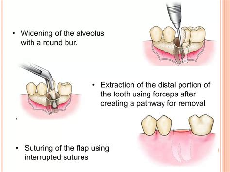 Principles and steps of surgical tooth extraction | PPTX