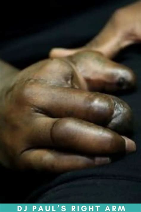 What Happened to Dj Paul's Hand?