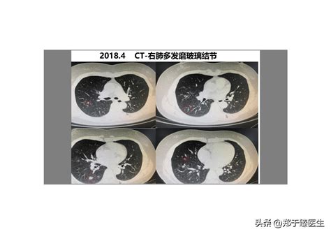 [Ground glass nodules] follow-up points and common treatment methods ...