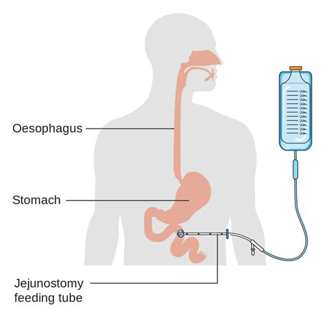Difference Between Parenteral And Enteral Nutrition at Lacey Chandler blog