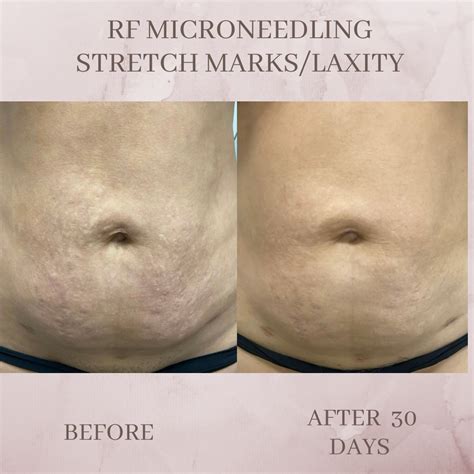 Track Marks From Microneedling at Victoria Ranford blog