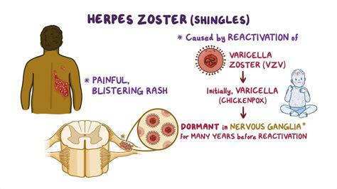 Herpes Zoster Shingles Virus