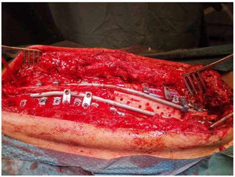 Efficacy and Risks of Posterior Vertebral Column Resection in the ...